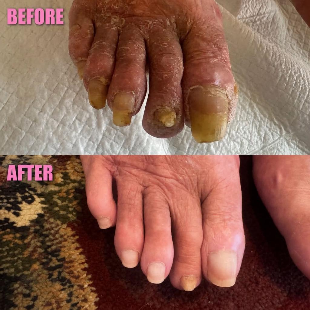 Before and after an in-home medical pedicure by Magnolia Recovery and Footcare: thick, overgrown toenails trimmed and dry, flaking skin cleared